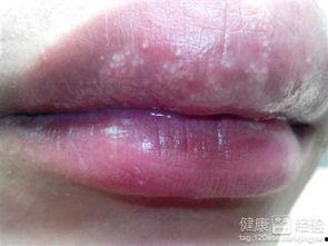 吃瓜嘴角红斑图片,健康警示与日常防护